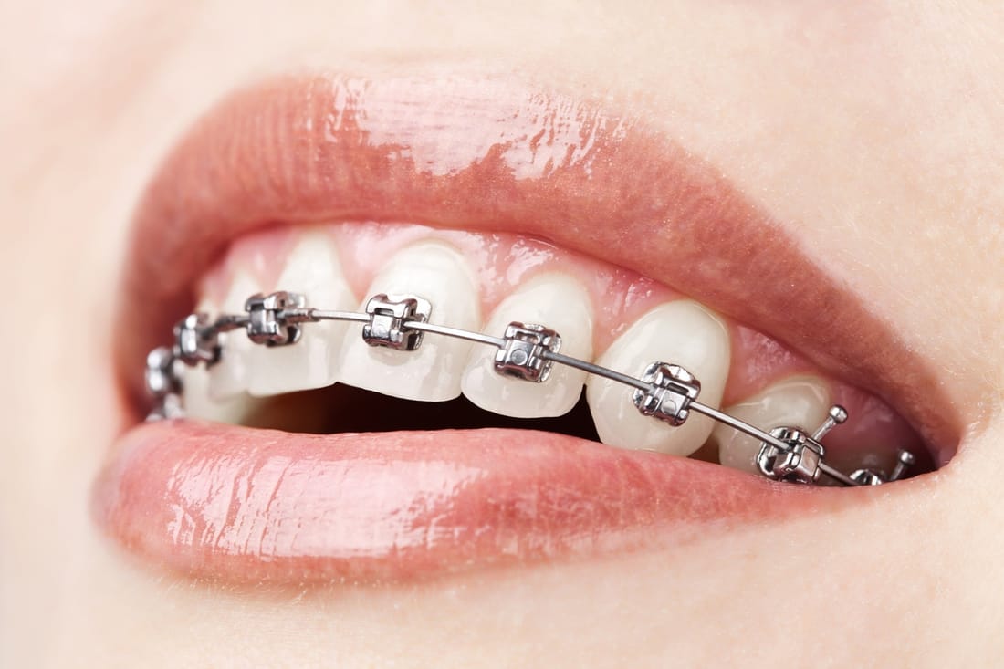 Self-Ligating Braces (Metal)